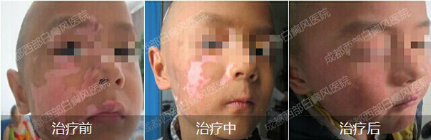 成都最好的白癜风医院